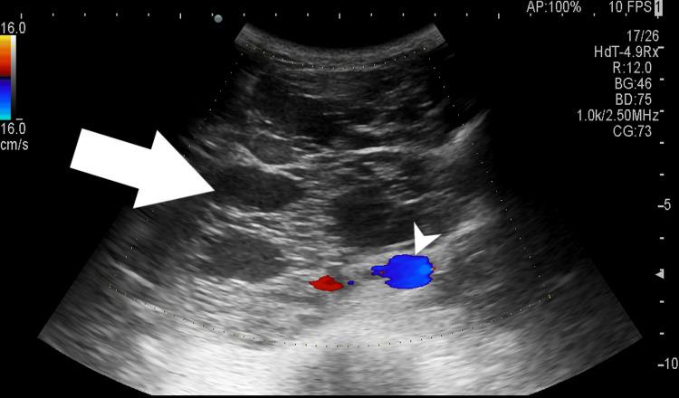 https://cdn.ncbi.nlm.nih.gov/pmc/blobs/d2a3/11137605/17d7e2a29bb9/cureus-0016-00000059335-i01.jpg