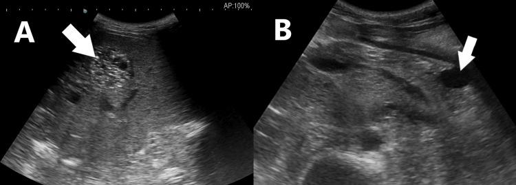 https://cdn.ncbi.nlm.nih.gov/pmc/blobs/d2a3/11137605/20d6e7623a36/cureus-0016-00000059335-i02.jpg