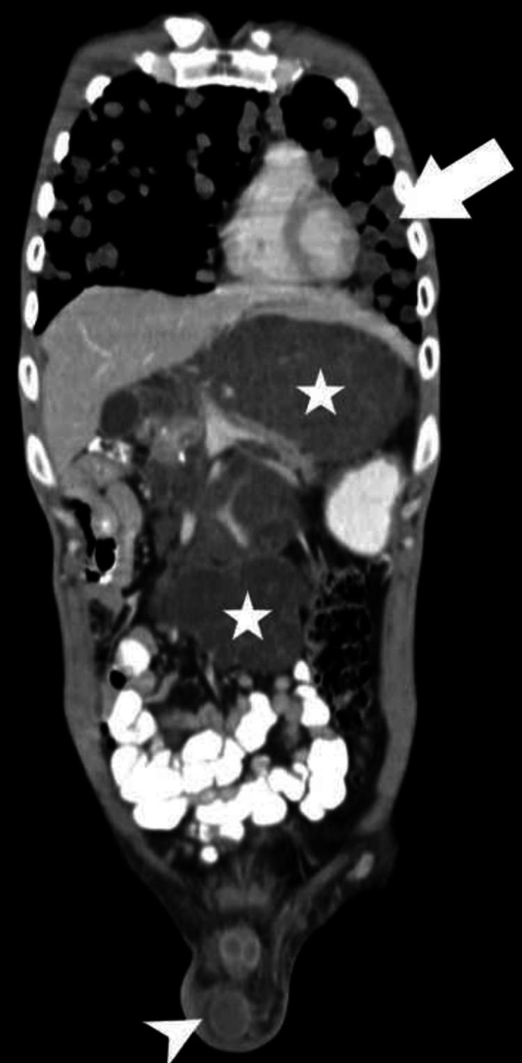 https://cdn.ncbi.nlm.nih.gov/pmc/blobs/d2a3/11137605/8c3f5a276ce5/cureus-0016-00000059335-i04.jpg