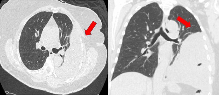 https://cdn.ncbi.nlm.nih.gov/pmc/blobs/d2b0/10228835/5ce010debf35/cureus-0015-00000038341-i02.jpg