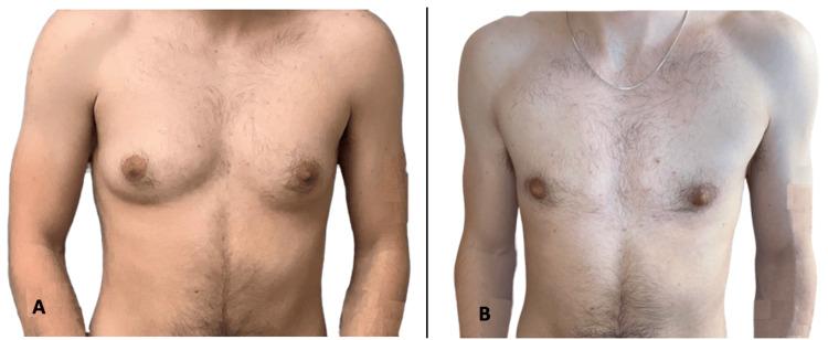 https://cdn.ncbi.nlm.nih.gov/pmc/blobs/d308/12004420/4da7efa76a0c/cureus-0017-00000080757-i01.jpg