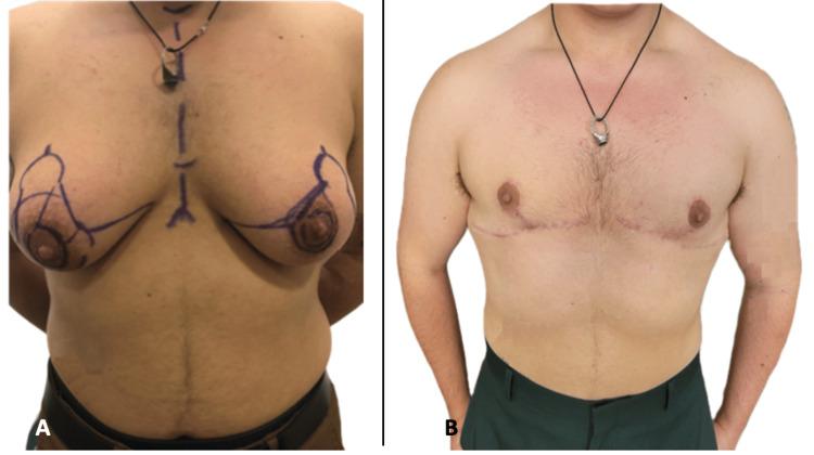 https://cdn.ncbi.nlm.nih.gov/pmc/blobs/d308/12004420/9fc841bf855c/cureus-0017-00000080757-i04.jpg