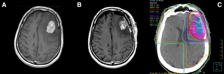 https://cdn.ncbi.nlm.nih.gov/pmc/blobs/d30d/11841999/f27b30de5496/cureus-0017-00000077762-i01.jpg