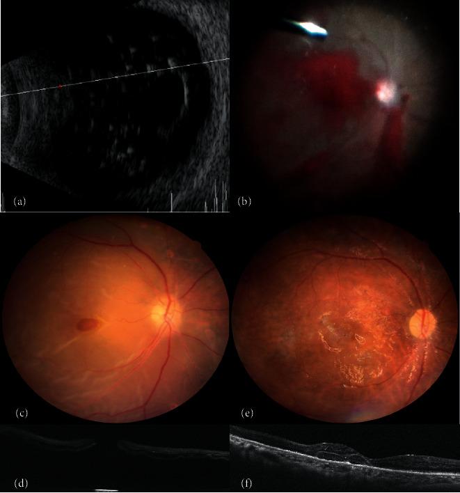 https://cdn.ncbi.nlm.nih.gov/pmc/blobs/d30e/9173914/a5c6e677ef72/JOPH2022-3156642.003.jpg