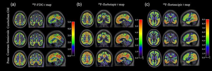 https://cdn.ncbi.nlm.nih.gov/pmc/blobs/d31c/8996354/7ad14113d9e1/HBM-43-2121-g009.jpg