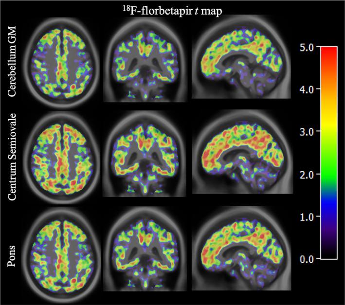 https://cdn.ncbi.nlm.nih.gov/pmc/blobs/d31c/8996354/e13401c8219b/HBM-43-2121-g005.jpg