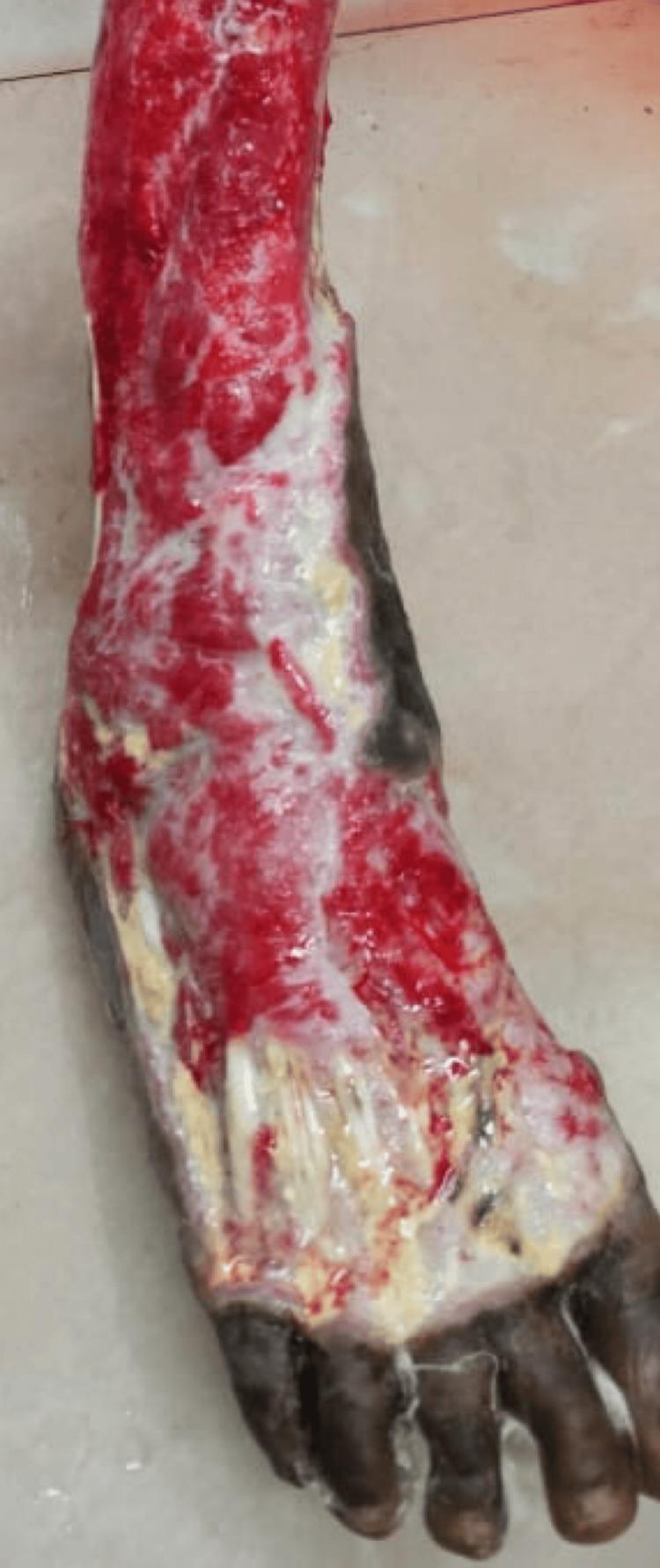 https://cdn.ncbi.nlm.nih.gov/pmc/blobs/d324/11484888/a6f2f679e676/cureus-0016-00000071705-i02.jpg