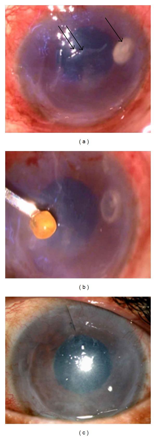 https://cdn.ncbi.nlm.nih.gov/pmc/blobs/d343/3350162/8ce6b3ec5286/CRIM.OPHMED2011-850919.001.jpg