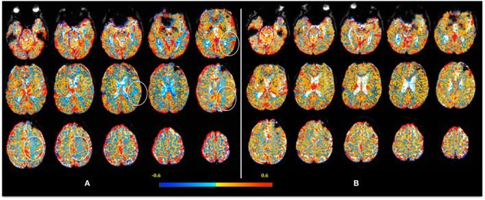 https://cdn.ncbi.nlm.nih.gov/pmc/blobs/d389/4862985/3935d361caa0/fneur-07-00070-g001.jpg