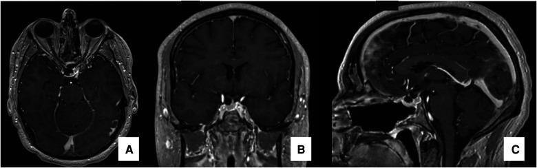https://cdn.ncbi.nlm.nih.gov/pmc/blobs/d3f5/9990524/381337e7dfd1/fsurg-10-1073736-g003.jpg