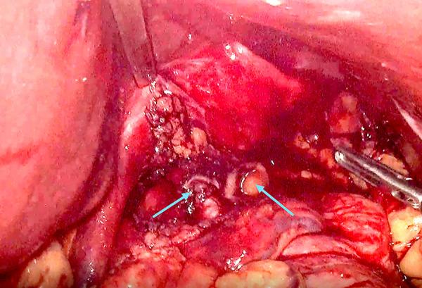 https://cdn.ncbi.nlm.nih.gov/pmc/blobs/d421/10750802/15810465156e/amjcaserep-24-e942371-g004.jpg