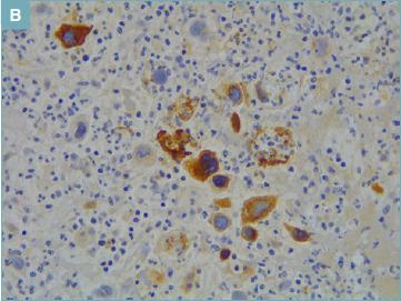 https://cdn.ncbi.nlm.nih.gov/pmc/blobs/d473/10342216/9ee1e91899f7/pathol-2023-01-32-g004.jpg