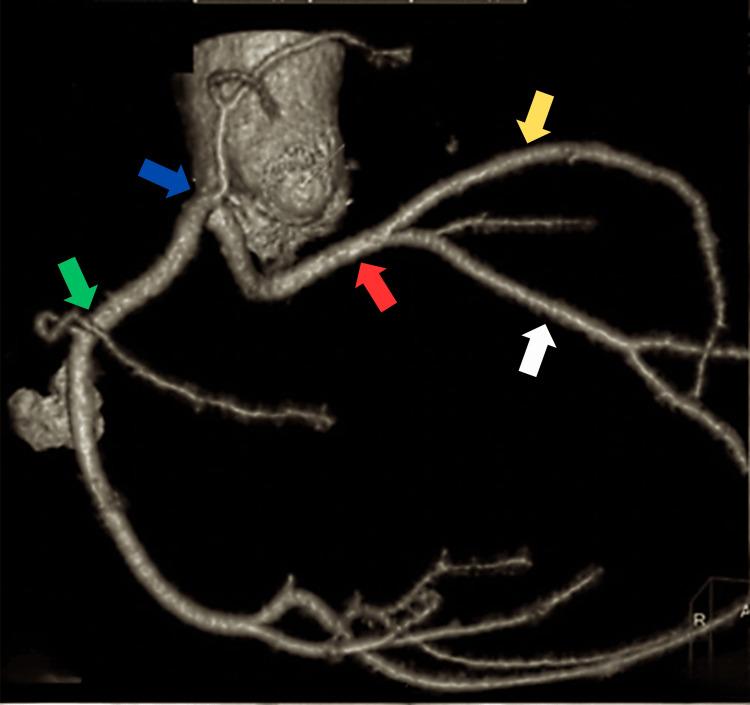 https://cdn.ncbi.nlm.nih.gov/pmc/blobs/d47d/11144023/e7f21594df7c/cureus-0016-00000061505-i02.jpg