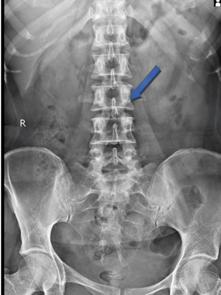 https://cdn.ncbi.nlm.nih.gov/pmc/blobs/d4a7/11228404/be48ad7fbf90/cureus-0016-00000061868-i01.jpg