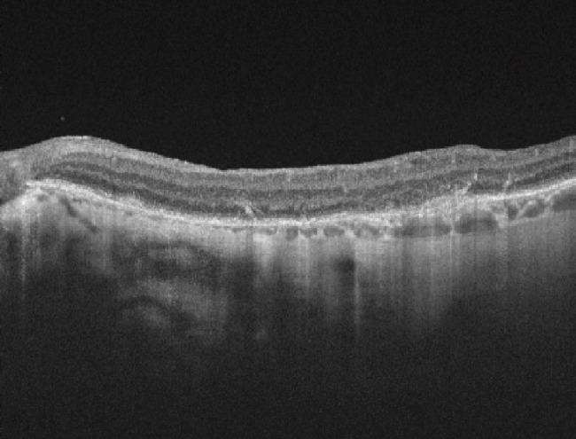 https://cdn.ncbi.nlm.nih.gov/pmc/blobs/d4e7/9022146/dc41c4bc7b6a/RomJOphthalmol-66-79-g003.jpg