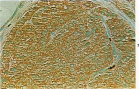 https://cdn.ncbi.nlm.nih.gov/pmc/blobs/d52e/2032435/86d6af503ccf/amjpathol00449-0099-b.jpg