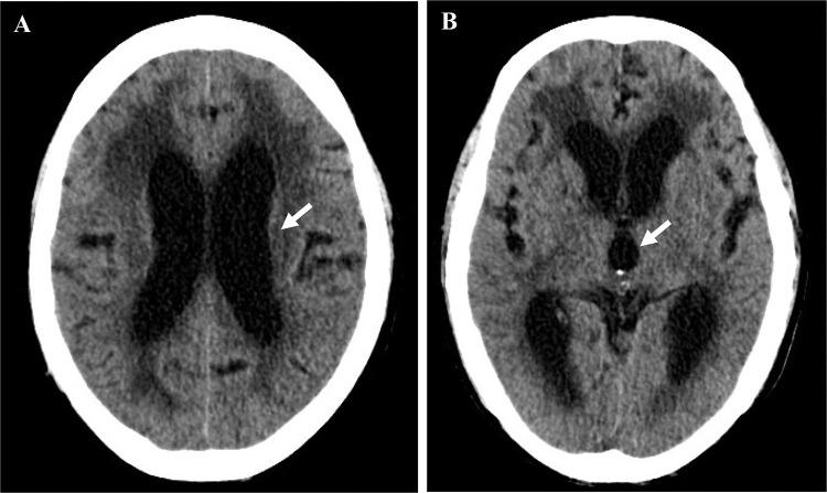 https://cdn.ncbi.nlm.nih.gov/pmc/blobs/d53d/11193441/a866870c06c3/OTT-17-499-g0005.jpg