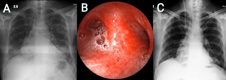 https://cdn.ncbi.nlm.nih.gov/pmc/blobs/d560/11221396/99de9252a9b4/cureus-0016-00000061556-i03.jpg