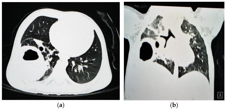 https://cdn.ncbi.nlm.nih.gov/pmc/blobs/d61e/11727648/c499e4331bbc/jcm-13-07790-g003.jpg