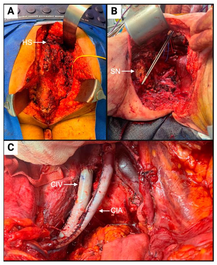 https://cdn.ncbi.nlm.nih.gov/pmc/blobs/d672/11719841/e334bd53a9dc/cancers-17-00111-g001.jpg