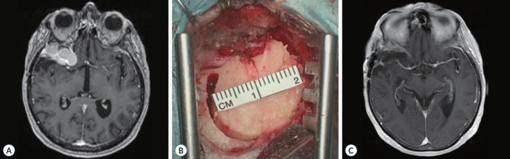 https://cdn.ncbi.nlm.nih.gov/pmc/blobs/d6ab/11725459/2e3829ea0bcc/jkns-2024-0085f4.jpg