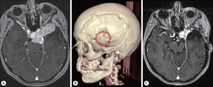 https://cdn.ncbi.nlm.nih.gov/pmc/blobs/d6ab/11725459/324d0d67a524/jkns-2024-0085f7.jpg