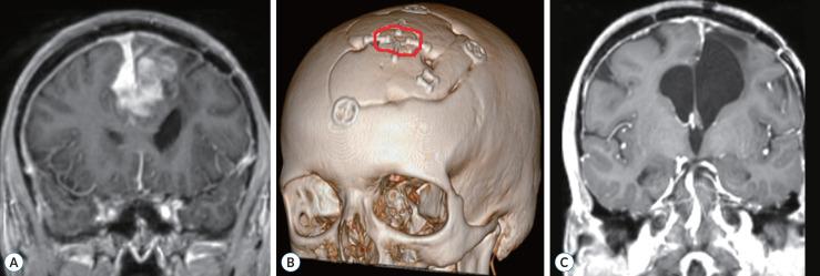 https://cdn.ncbi.nlm.nih.gov/pmc/blobs/d6ab/11725459/7098150d22e7/jkns-2024-0085f1.jpg