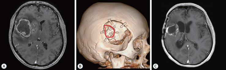 https://cdn.ncbi.nlm.nih.gov/pmc/blobs/d6ab/11725459/c886f302b7f3/jkns-2024-0085f5.jpg