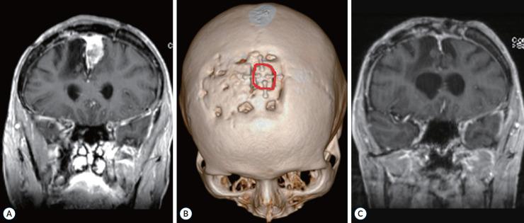 https://cdn.ncbi.nlm.nih.gov/pmc/blobs/d6ab/11725459/cc8ce9494919/jkns-2024-0085f3.jpg