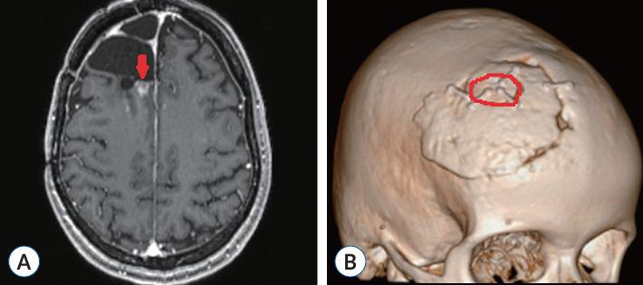 https://cdn.ncbi.nlm.nih.gov/pmc/blobs/d6ab/11725459/d5c171257747/jkns-2024-0085f2.jpg