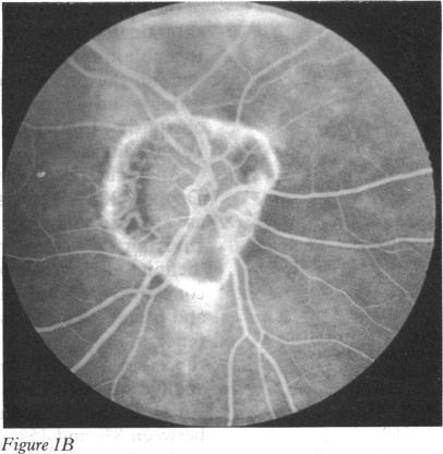 https://cdn.ncbi.nlm.nih.gov/pmc/blobs/d6e1/1042223/2f6d07a3bd0d/brjopthal00584-0005-b.jpg