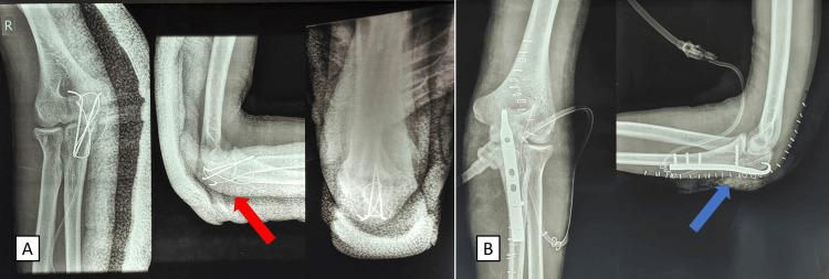 https://cdn.ncbi.nlm.nih.gov/pmc/blobs/d6f1/11374141/16691ec718d3/cureus-0016-00000066140-i02.jpg