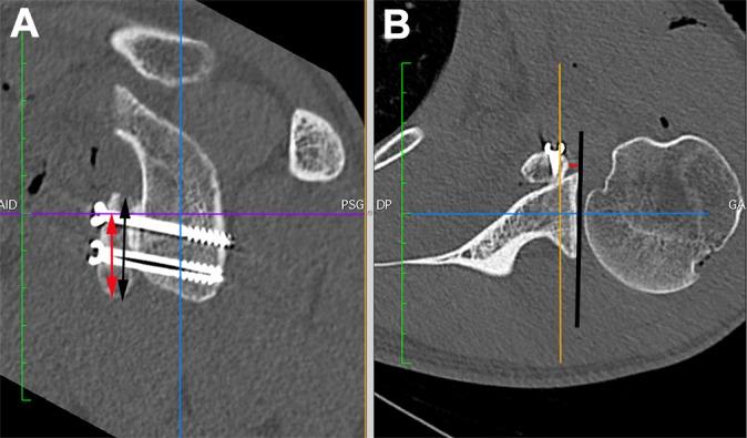 https://cdn.ncbi.nlm.nih.gov/pmc/blobs/d759/5652655/240428c2609c/10.1177_2325967117734218-fig2.jpg