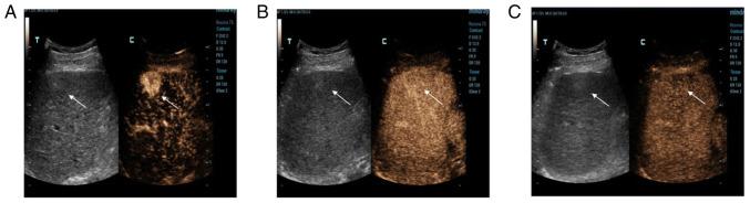 https://cdn.ncbi.nlm.nih.gov/pmc/blobs/d7ad/9121201/47c38c2ed7d5/etm-23-06-11358-g02.jpg