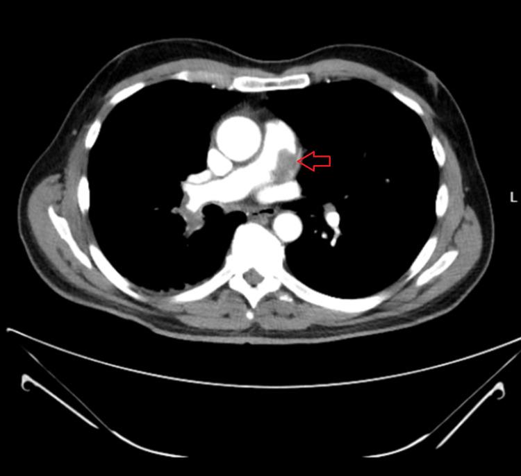 https://cdn.ncbi.nlm.nih.gov/pmc/blobs/d809/9165929/5928bee28491/cureus-0014-00000024734-i01.jpg