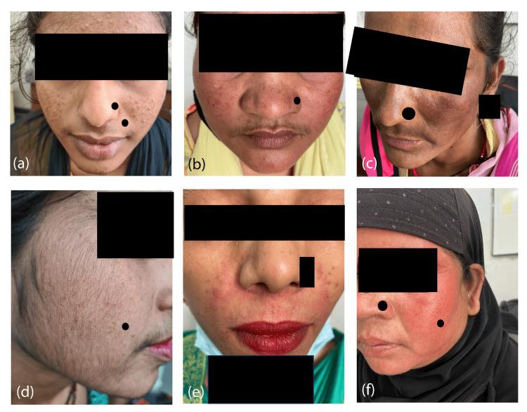 https://cdn.ncbi.nlm.nih.gov/pmc/blobs/d828/11723967/16c6f133886e/cureus-0016-00000075566-i01.jpg