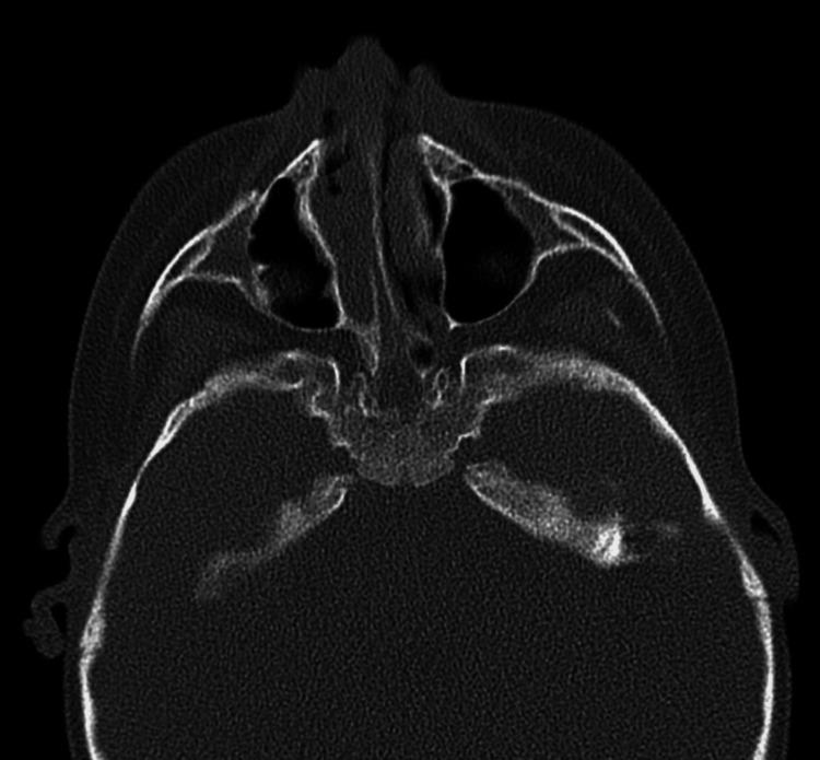 https://cdn.ncbi.nlm.nih.gov/pmc/blobs/d89d/9462955/21dcc6fc4842/cureus-0014-00000028928-i03.jpg