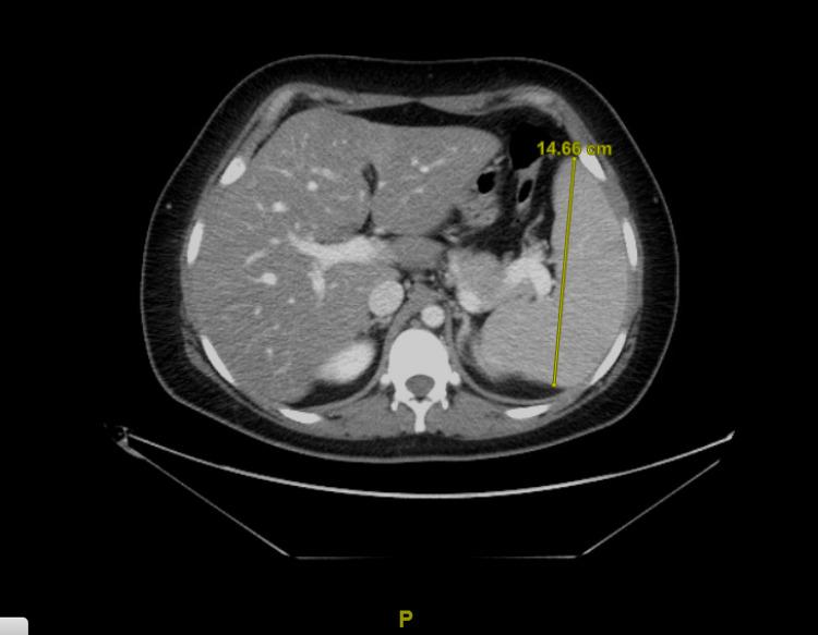 https://cdn.ncbi.nlm.nih.gov/pmc/blobs/d901/8958274/bb7068b94cd0/cureus-0014-00000022614-i01.jpg