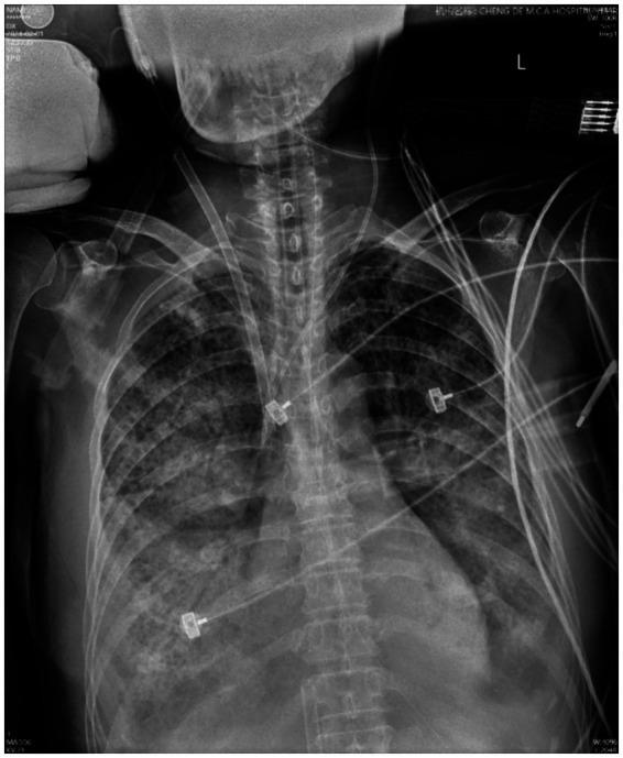 https://cdn.ncbi.nlm.nih.gov/pmc/blobs/d941/12040869/34960a1d81d4/fmed-12-1549856-g002.jpg