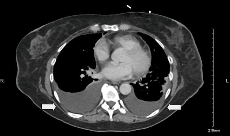 https://cdn.ncbi.nlm.nih.gov/pmc/blobs/d990/12121972/0d9a142eb26c/cureus-0017-00000083153-i03.jpg