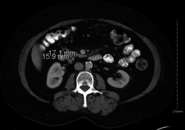 https://cdn.ncbi.nlm.nih.gov/pmc/blobs/d990/12121972/59219c040d9a/cureus-0017-00000083153-i01.jpg
