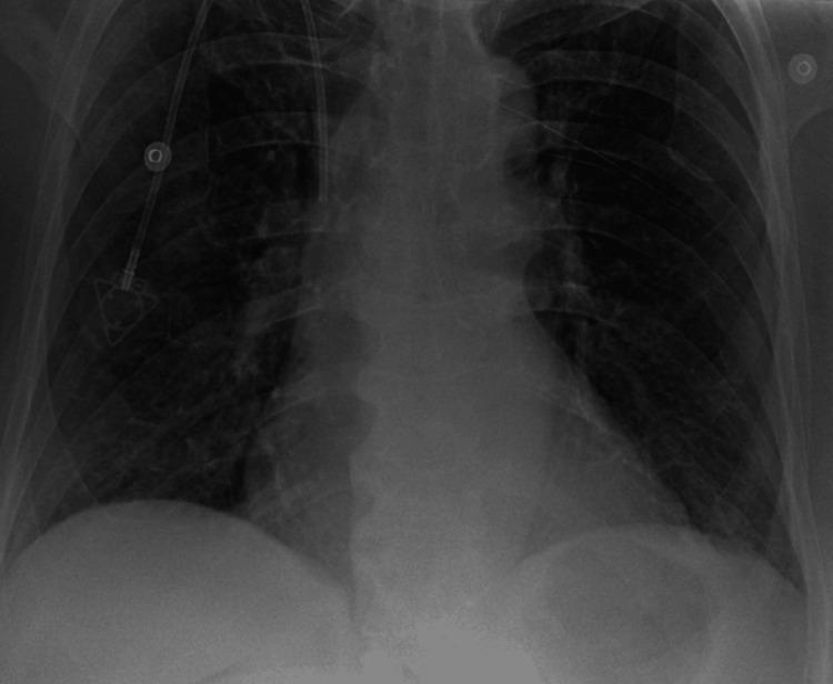 https://cdn.ncbi.nlm.nih.gov/pmc/blobs/d990/12121972/6a793cf400f5/cureus-0017-00000083153-i04.jpg