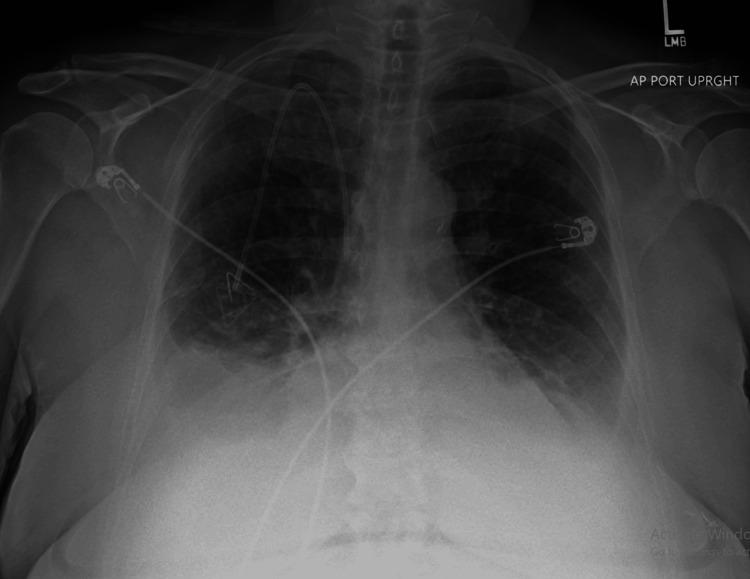https://cdn.ncbi.nlm.nih.gov/pmc/blobs/d990/12121972/ad61742e556b/cureus-0017-00000083153-i02.jpg