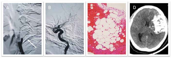 https://cdn.ncbi.nlm.nih.gov/pmc/blobs/d9be/10436317/2662f86bb377/fneur-14-1180333-g0002.jpg