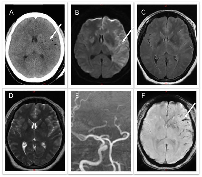 https://cdn.ncbi.nlm.nih.gov/pmc/blobs/d9be/10436317/c70e255549e1/fneur-14-1180333-g0001.jpg