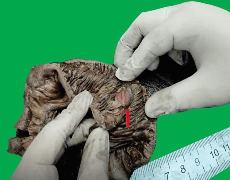 https://cdn.ncbi.nlm.nih.gov/pmc/blobs/da26/11703656/08c28ab2a672/cureus-0016-00000075244-i02.jpg