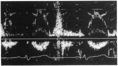 https://cdn.ncbi.nlm.nih.gov/pmc/blobs/da74/1024647/a2ffe81ba677/brheartj00045-0027-a.jpg