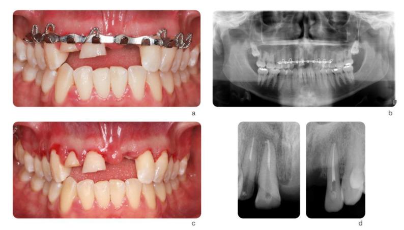 https://cdn.ncbi.nlm.nih.gov/pmc/blobs/da9b/8005016/154f3b3d45b9/dentistry-09-00033-g002.jpg