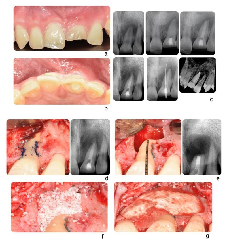 https://cdn.ncbi.nlm.nih.gov/pmc/blobs/da9b/8005016/21e89e242d4b/dentistry-09-00033-g005a.jpg