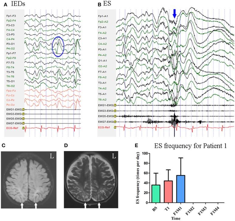 https://cdn.ncbi.nlm.nih.gov/pmc/blobs/db1e/6370643/761f4ba00fbd/fneur-10-00050-g0002.jpg